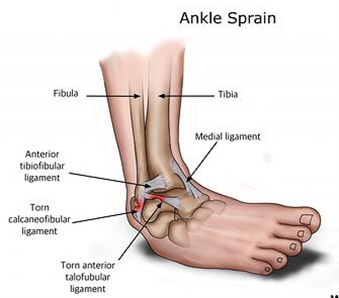 File:Ankle-injury.png